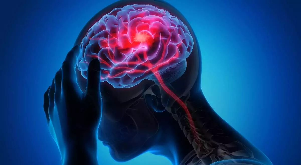 Bell's Palsy Vs Strokes