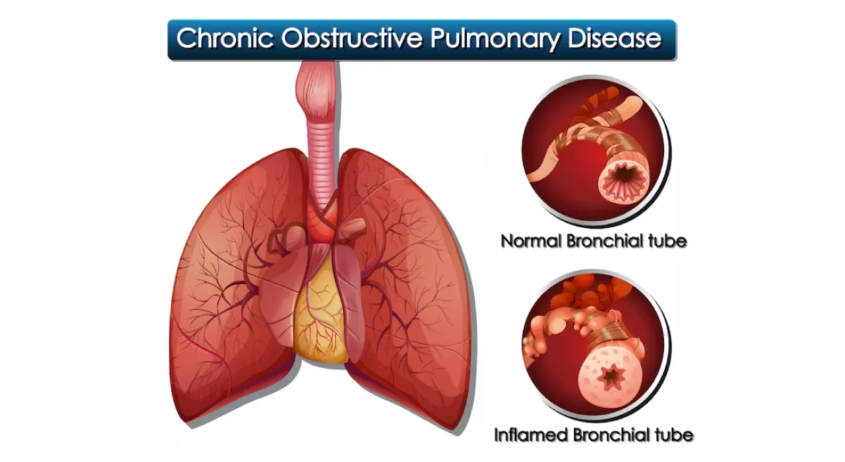 copd