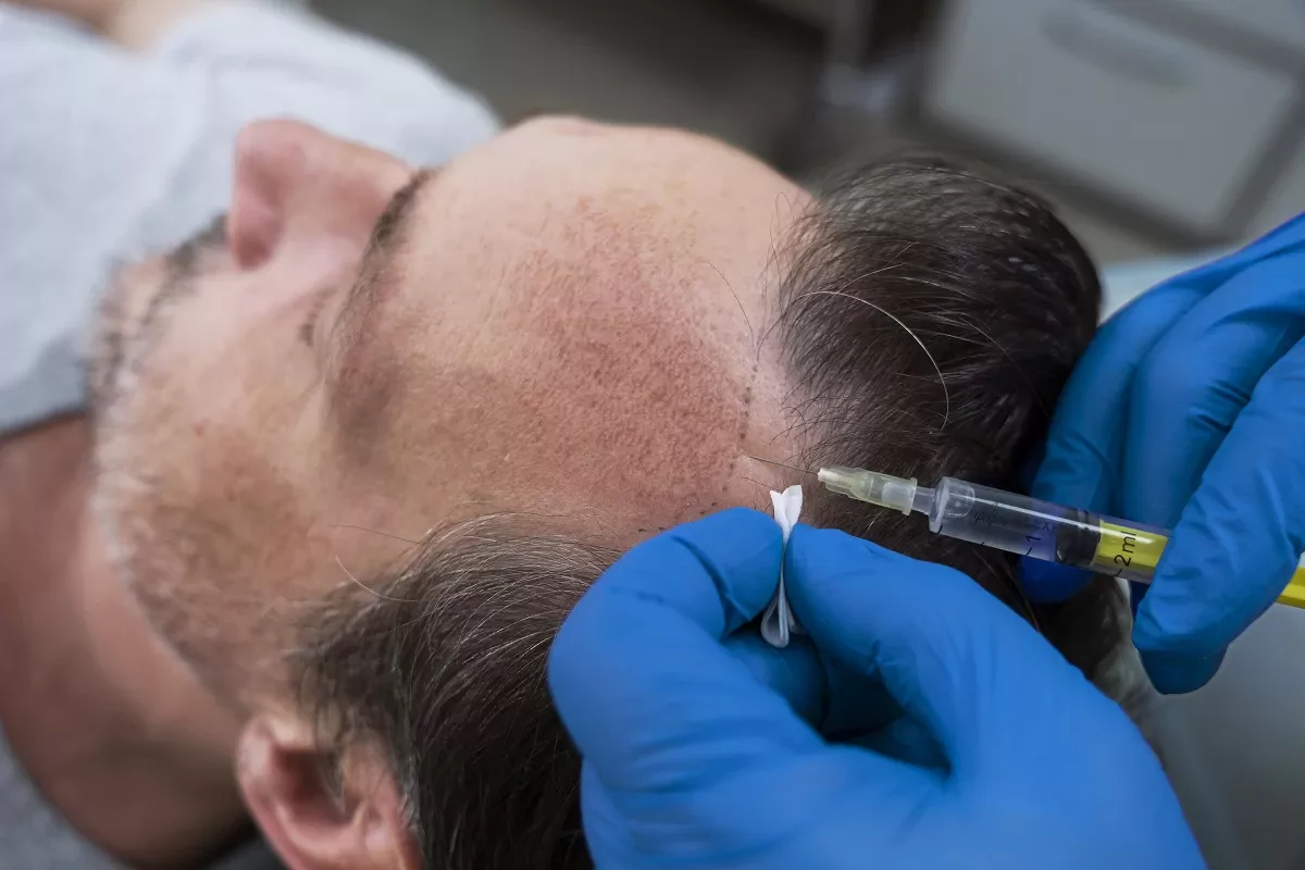 hair transplant 