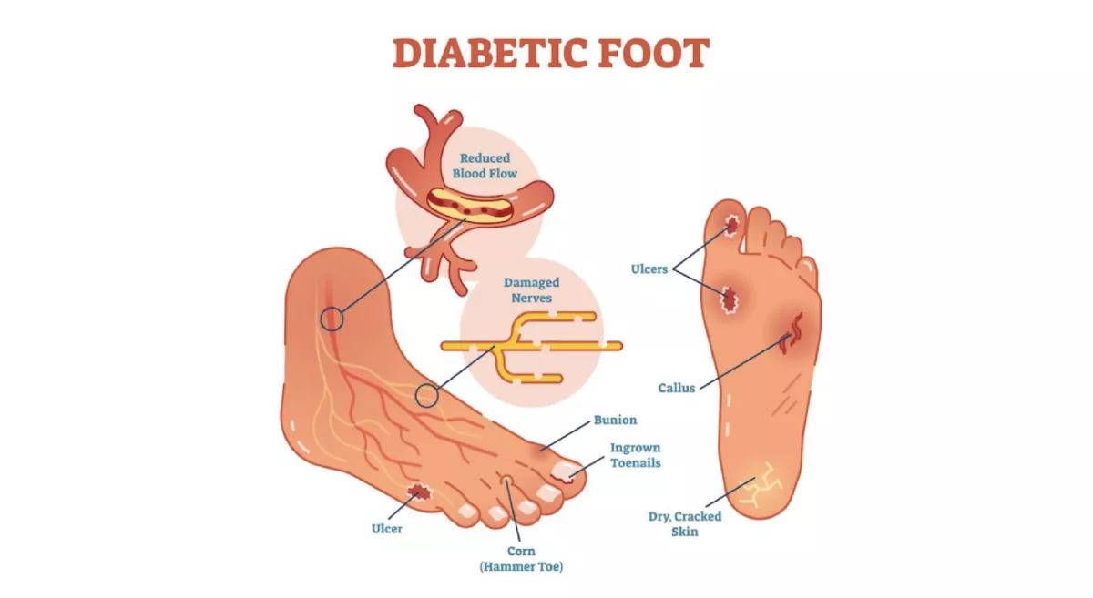 Diabetic Foot Ulcer Treatment in Bhopal | Dr Sunil Rathore