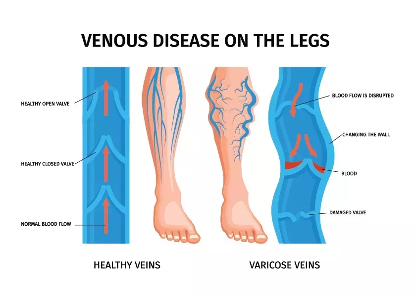 Varicose veins: Symptoms, Causes, Diagnosis, and Treatment