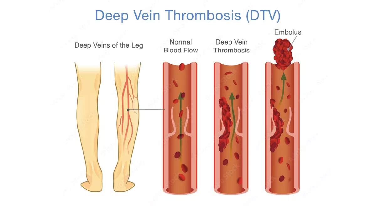 DVT