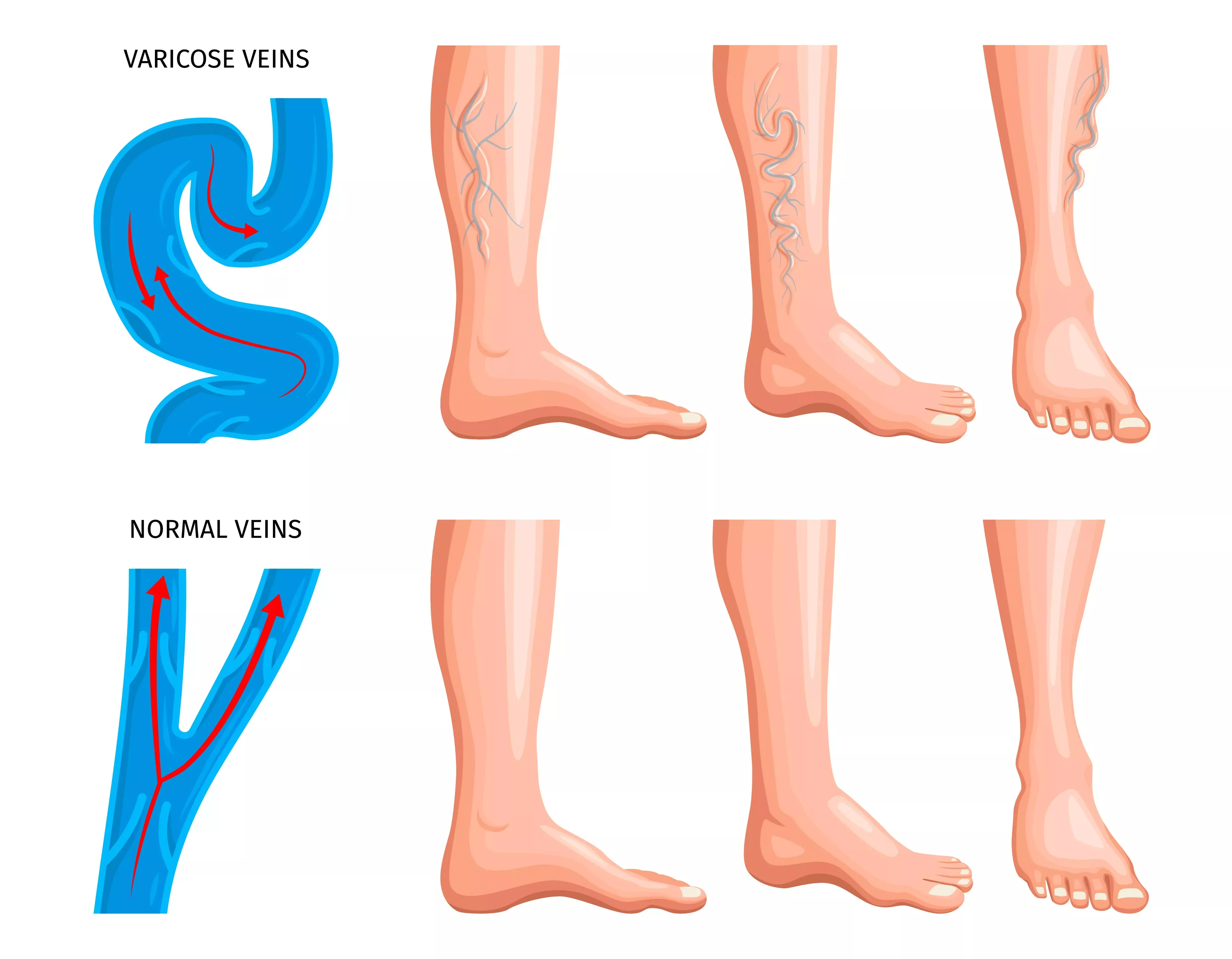 Varicose Veins