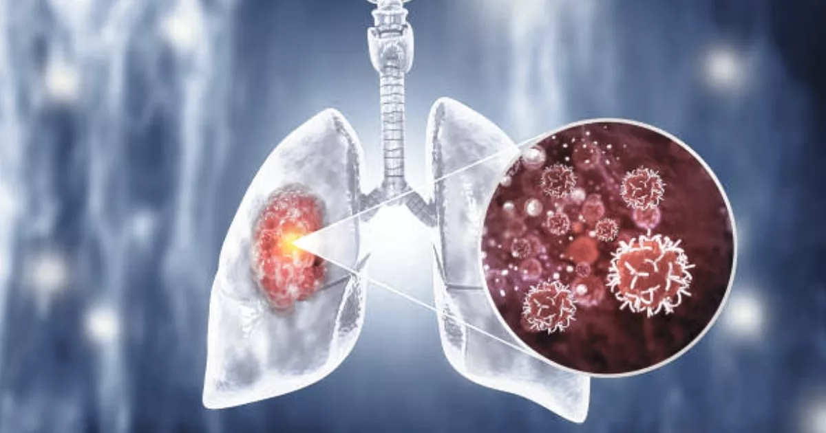 The Surge of Lung Cancer in Non-Smokers and Its Hidden Triggers