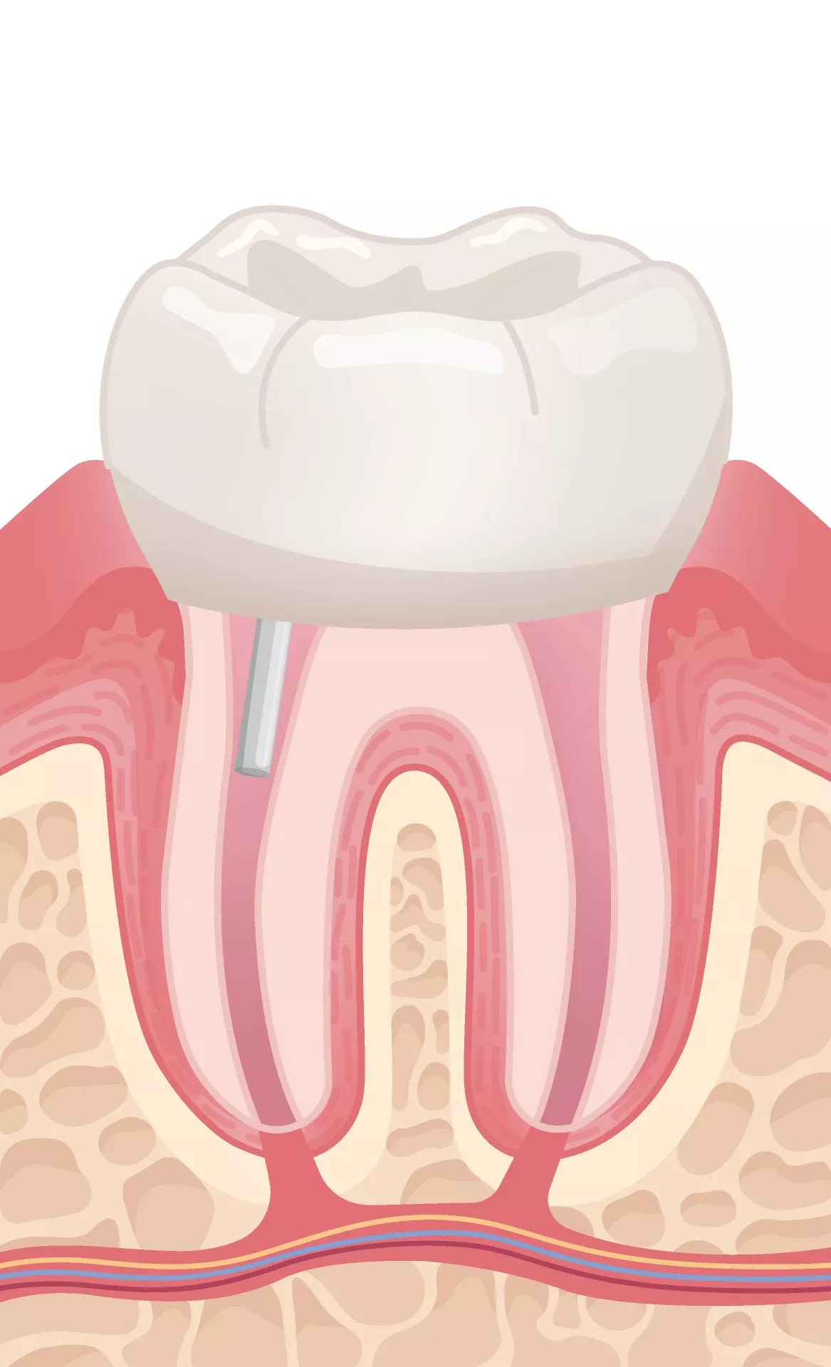 Post Root Canal Treatment.jpg