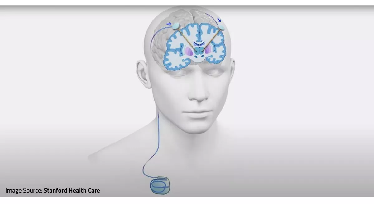 What is Deep Brain Stimulation (DBS) and its Association with Parkinson’s Disease?