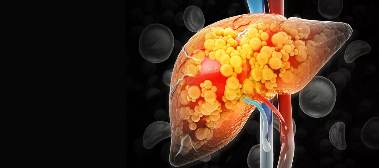 Fatty Liver