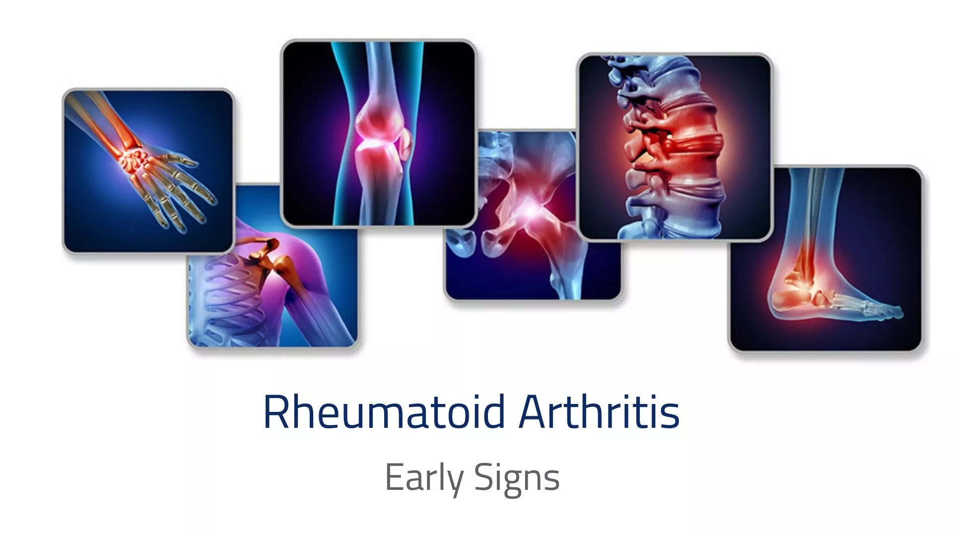 Early Signs of Rheumatoid Arthritis