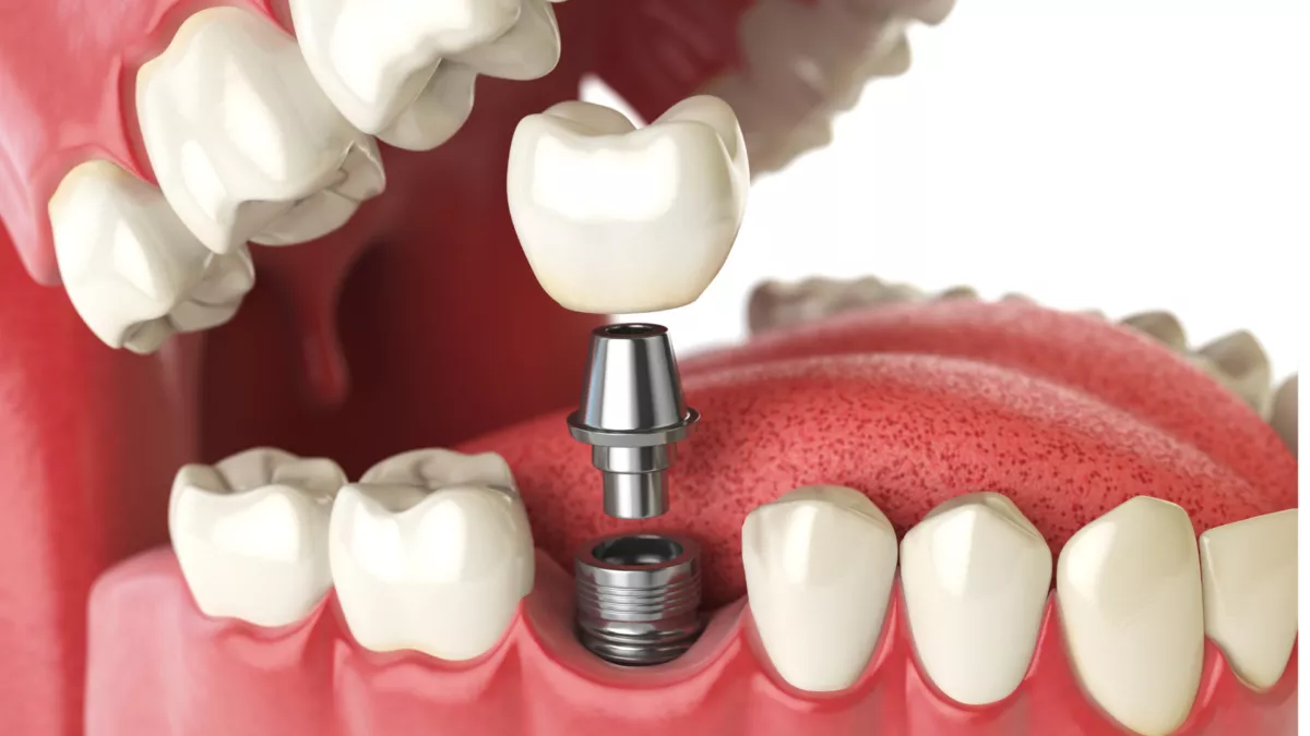 Dental Implants