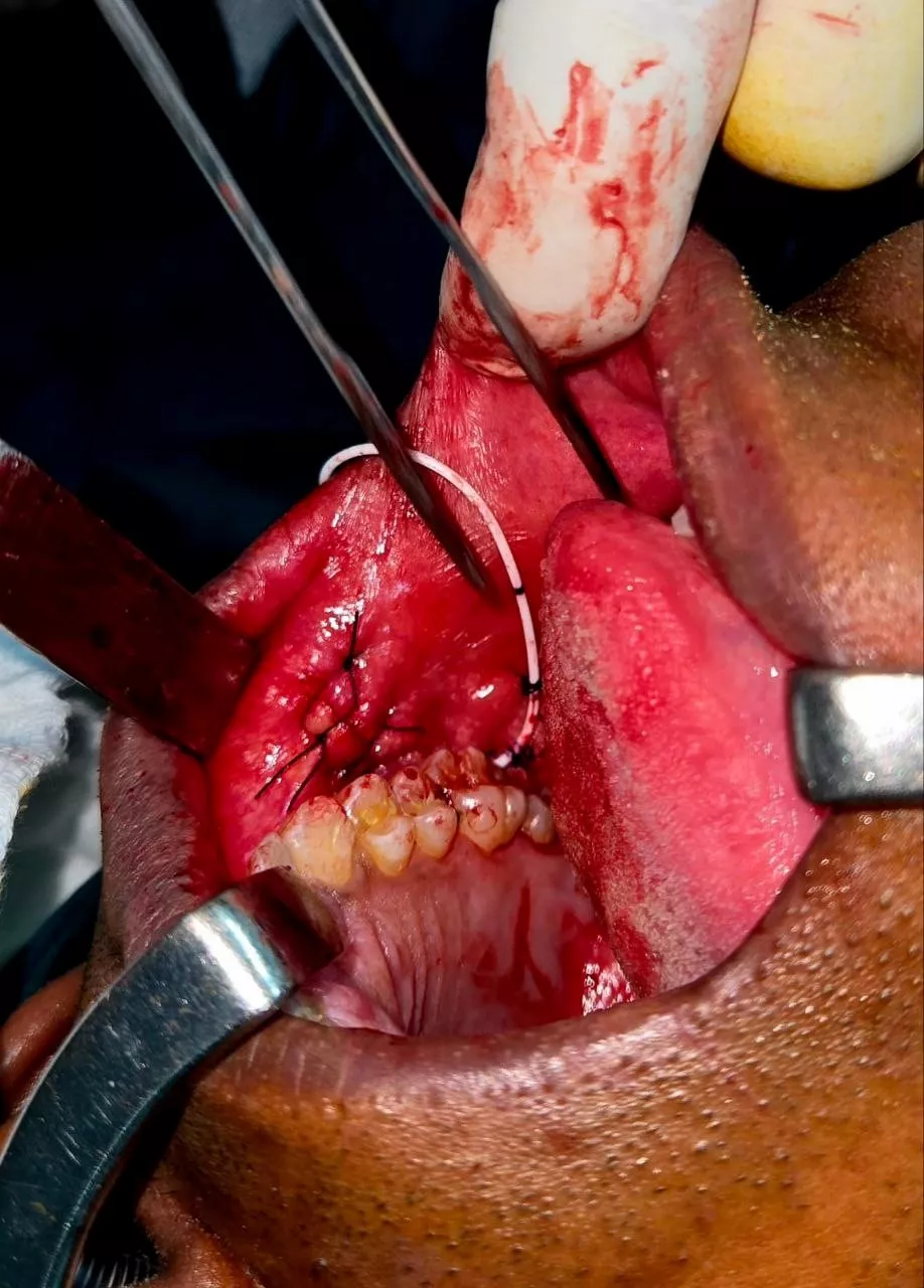 Fig. 5: Circumferential dissection around encapsulated adenoma.