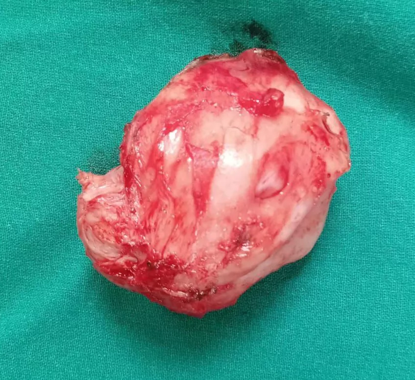 Caesarean myomectomy