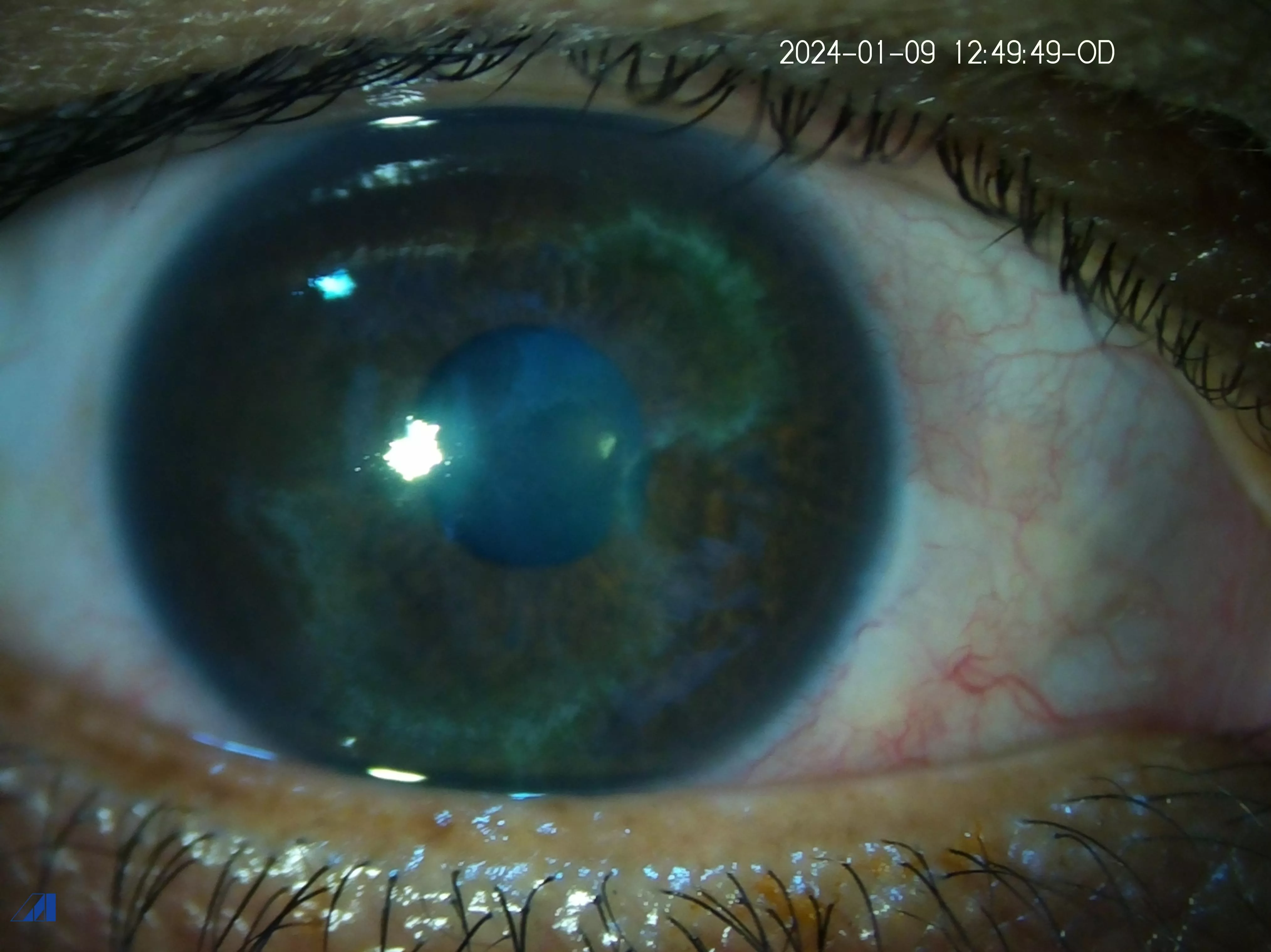Migratory Corneal 1 st presentation