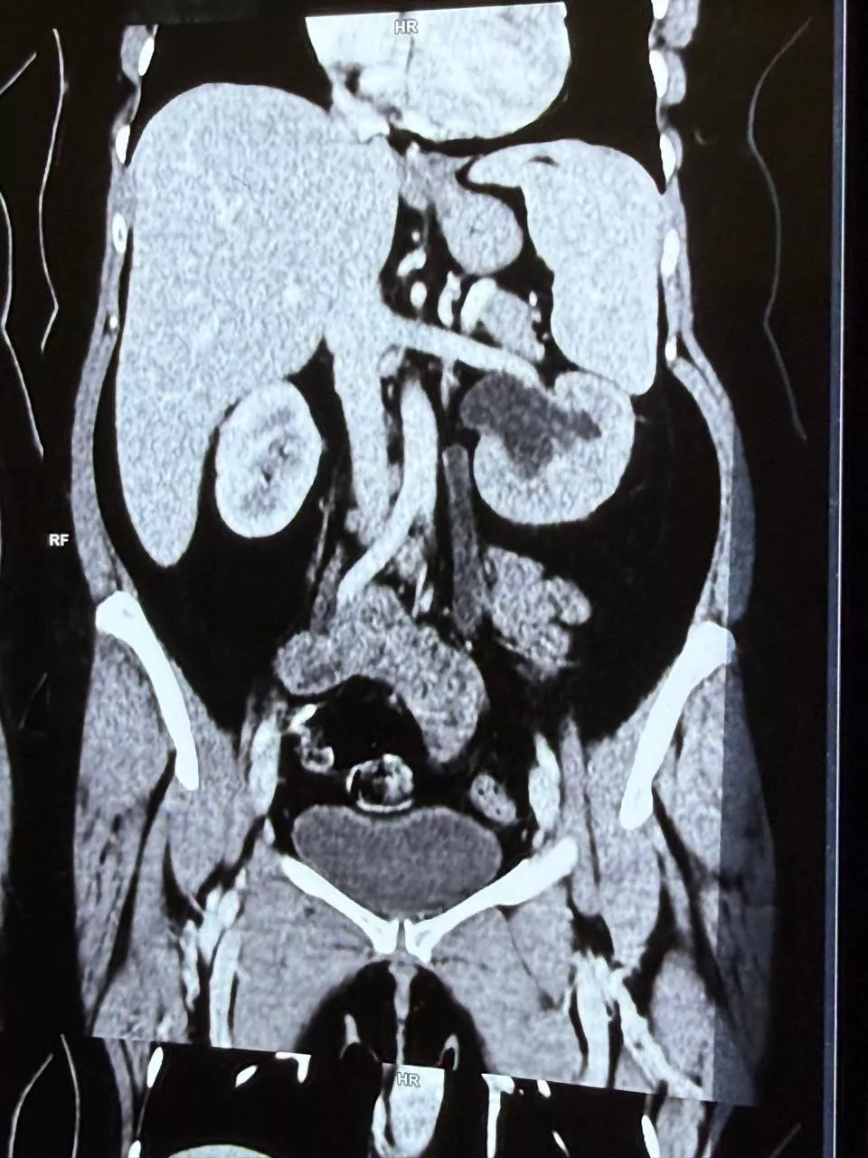 Uretero-Vaginal Fistula 