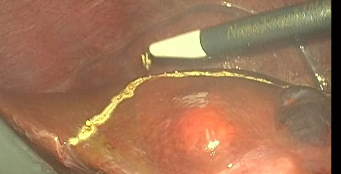 IV Recto-Sigmoid Adenocarcinoma.jpg