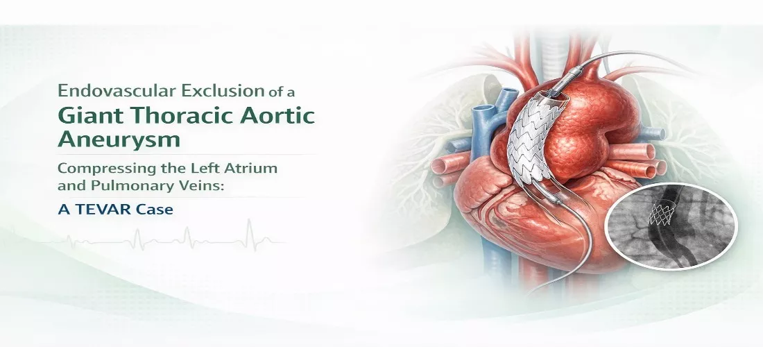 Endovascular Exclusion of a Giant Thoracic Aortic Aneurysm Compressing the Left Atrium and Pulmonary Veins: A TEVAR Case 1
