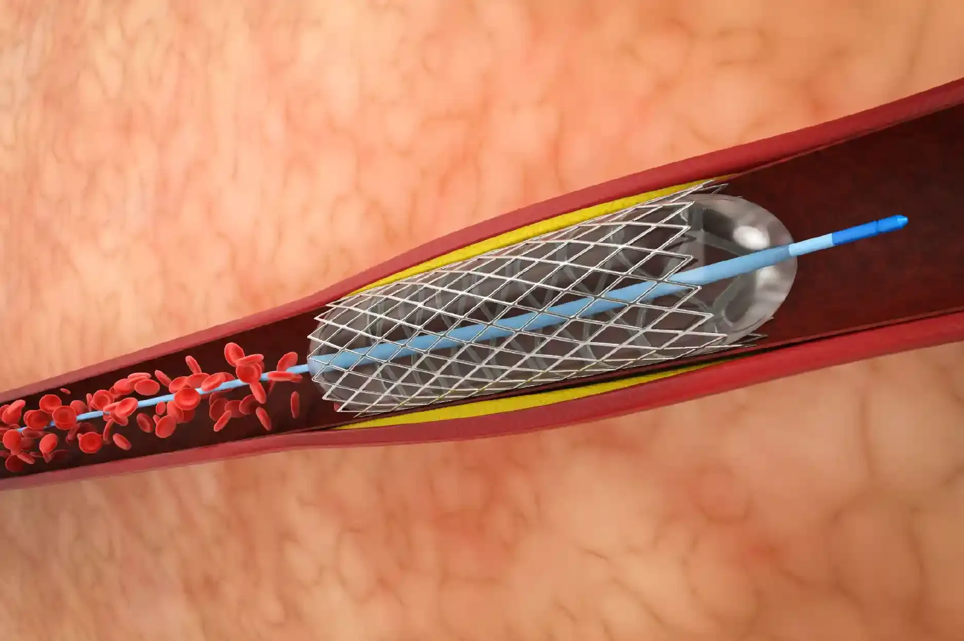 Precision Angioplasty