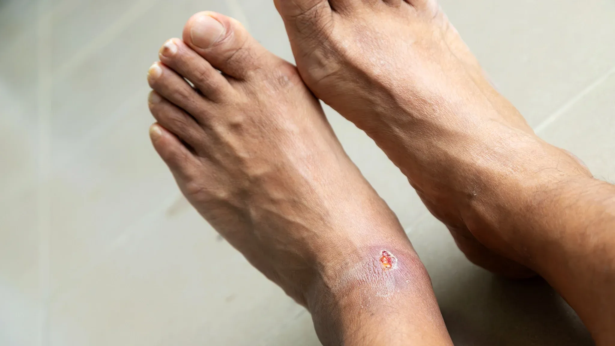 diabetic foot ulcer